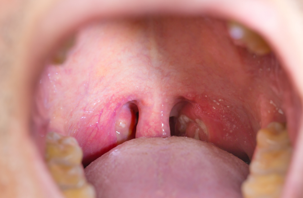 White Spots on Tonsils